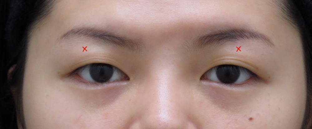 訂書針雙眼皮-彤顏-割雙眼皮-開放式雙眼皮-封閉式雙眼皮-取脂肪-修皮-泡泡眼-金魚眼-雙眼皮手術