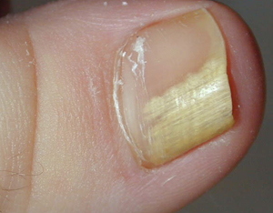 灰指甲-甲癬-指甲變色-指甲增厚變脆-甲床剝離-皮膚專科-灰指甲怎麼辦-灰指甲雷射-灰指甲治療方法