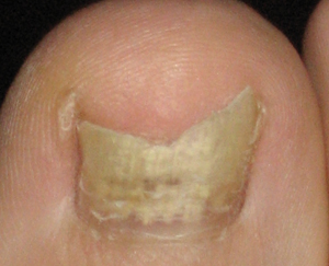 灰指甲-甲癬-指甲變色-指甲增厚變脆-甲床剝離-皮膚專科-皮膚管理專家