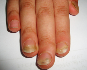 灰指甲-甲癬-指甲變色-指甲增厚變脆-甲床剝離-皮膚專科-皮膚管理專家-灰指甲怎麼辦-灰指甲雷射-灰指甲治療方法
