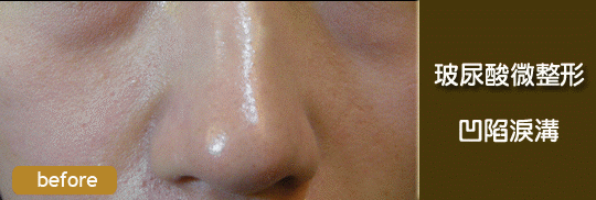 玻尿酸-水微晶-隆鼻-淚溝-法令紋-蘋果肌-墊下巴-豐唇-玻尿酸價格-玻尿酸豐頰-喬雅登-凝膠式玻尿酸-藝術面雕