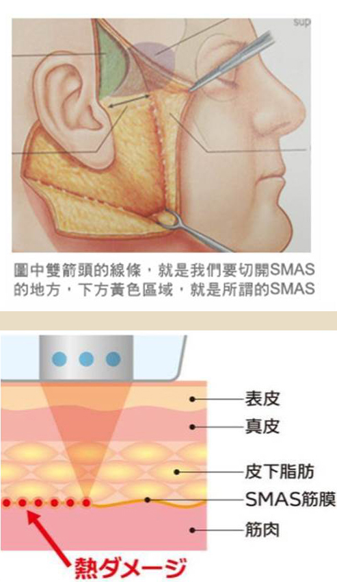 音波拉皮治療拉皮手術治療的緊膜層SMAS