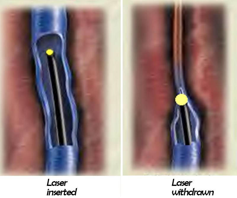 靜脈曲張-浮青筋-小腿爆青筋-靜脈曲張改善-靜脈曲張治療-體表血管雷射-微創血管手術-靜脈內雷射治療-EVLT-皮膚管理專家-靜脈曲張手術推薦-靜脈曲張手術費用
