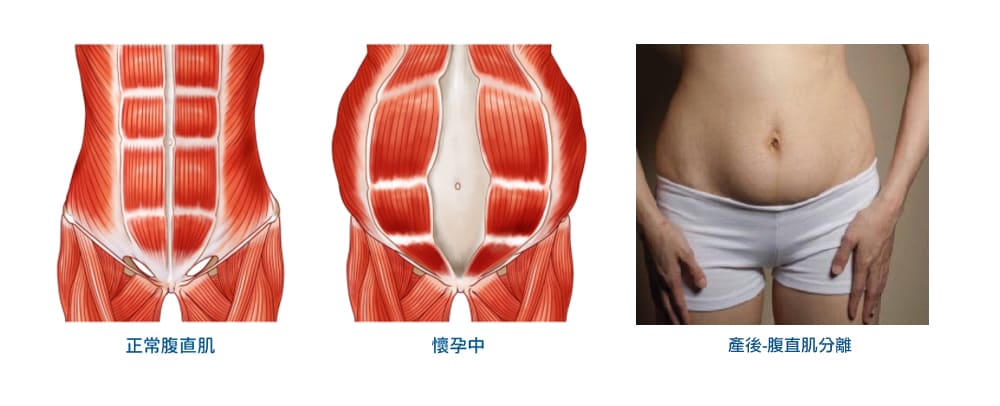 腹直肌分離-腹直肌修復-產後小腹肥胖-emsculpt-BTL馬甲線-瘦小腹-肌動減脂-增肌-減脂